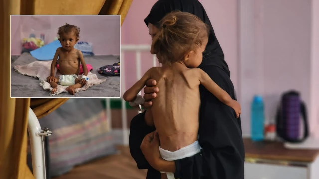 gazzede cocuklarda yetersiz beslenme vakalarinda artis yasaniyor yQrcEkH6